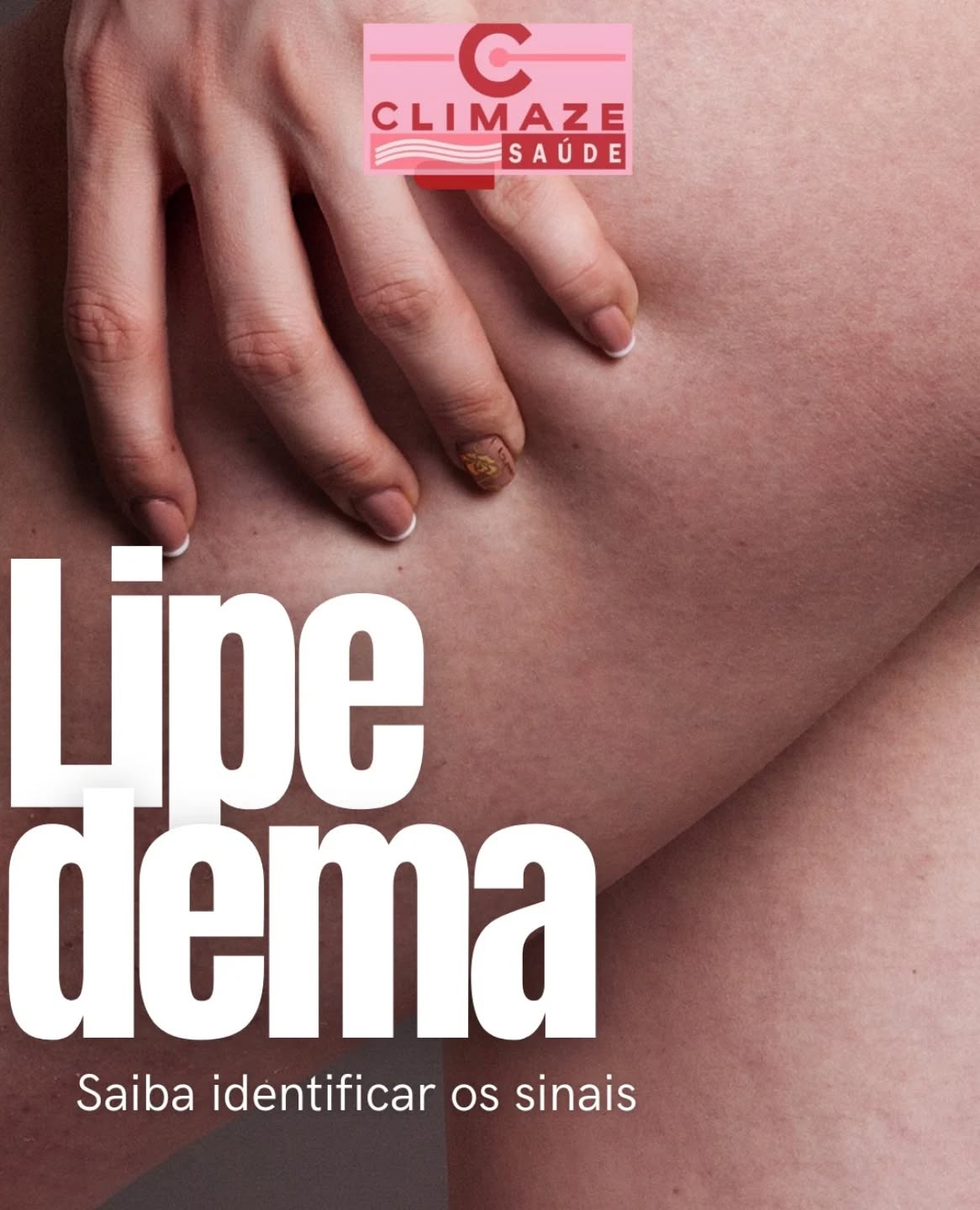 Você conhece os sinais do lipedema? 🌸

O lipedema é uma condição muitas vezes confundida com gordura localizada, mas vai muito além disso. Se você notar acúmulo de gordura nas pernas, quadris e braços, sem explicação aparente, pode ser um dos sinais dessa doença crônica.

🧐 Fique atento aos principais sinais do lipedema:

⚠️Aparência desigual: gordura concentrada nas coxas, quadris, panturrilhas e até nos braços.

⚠️Dor e sensibilidade: sensação de peso e dor ao toque, principalmente ao final do dia.

⚠️Inchaço constante: inchaço que não melhora com descanso ou dieta.

⚠️Não responde a exercícios: dificuldade em perder gordura nessas áreas, mesmo com dieta e treino.

🔎 O lipedema pode ser difícil de identificar, mas é importante buscar o diagnóstico correto. Quanto mais cedo for identificado, melhor será o tratamento!

💡 Está sentindo algum desses sintomas? Não espere mais para cuidar da sua saúde.

👉🏻 Digite "sim" para mais informações sobre o atendimento com a angiologista